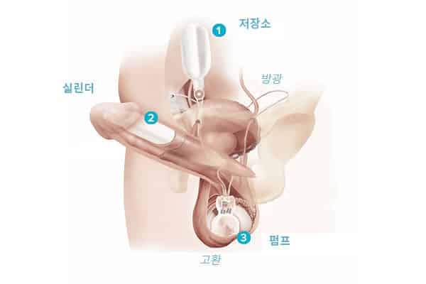팽창형 음경 보형물